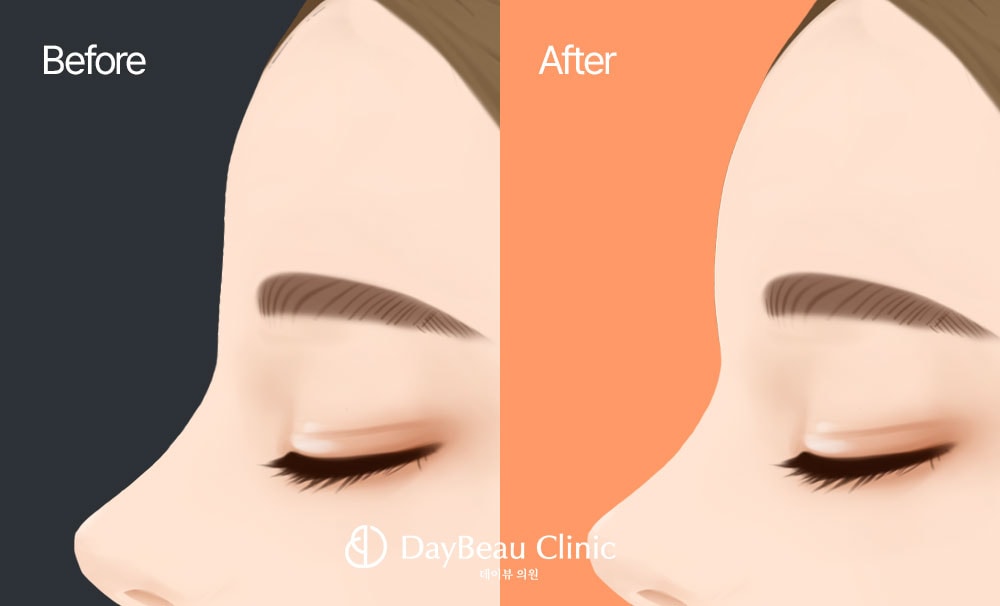 이마라인 볼륨 필러 (이마/관자/헤어라인) 추가정보